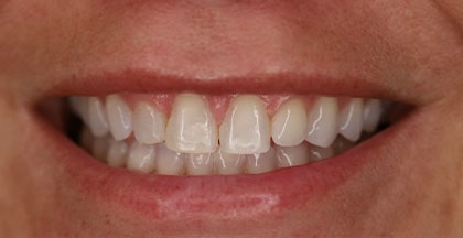 Before of porcelain veneers