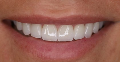 After of porcelain veneers