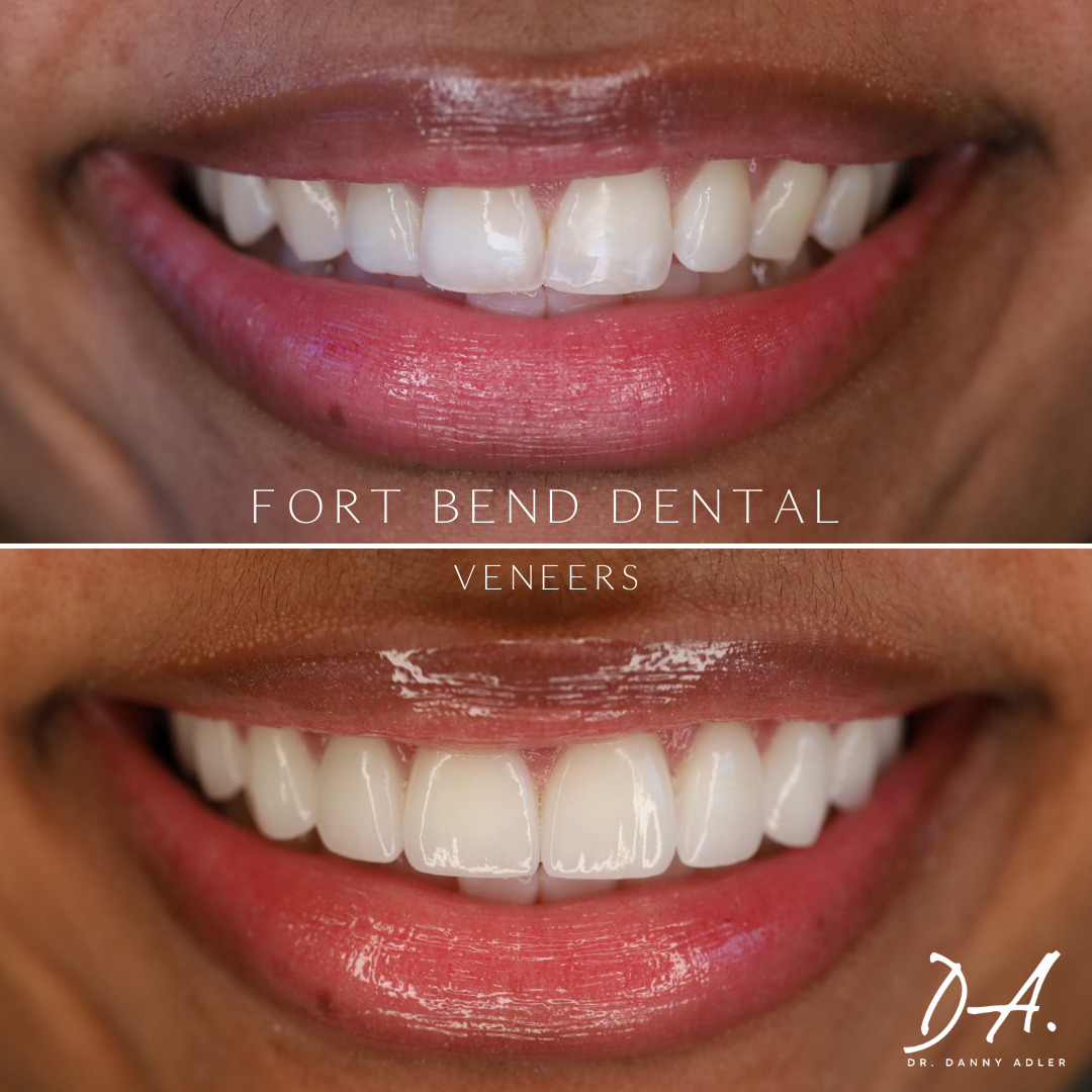 Veneers before & after