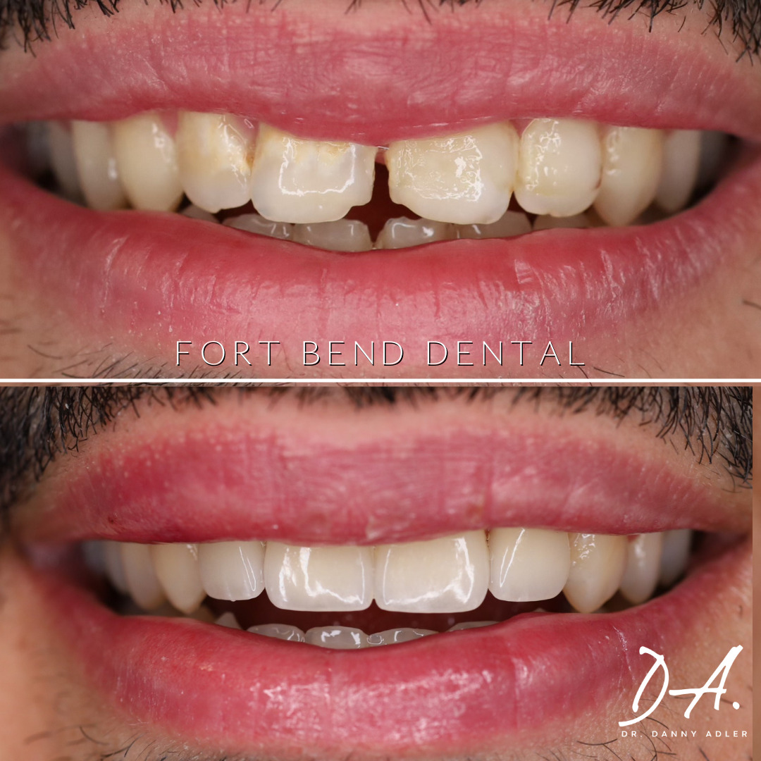 Veneers before & after