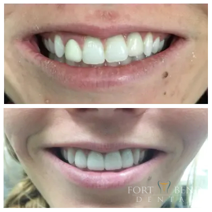 Veneers before & after